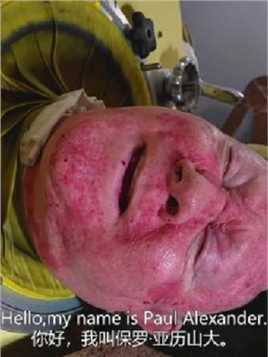 “困”在铁桶里70多年的男人，是目前世界上最久的“铁肺人”