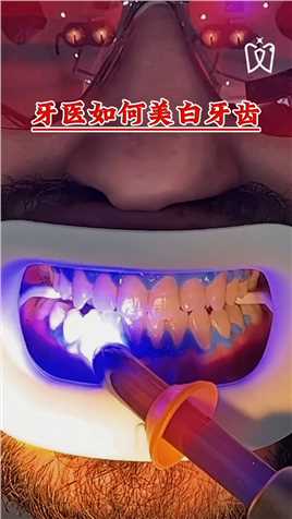 牙医如何美白牙齿