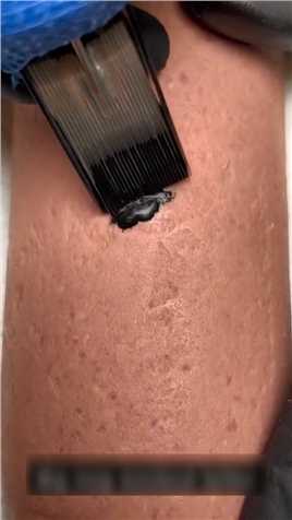 纹身的墨水是怎么保存在皮肤里的？