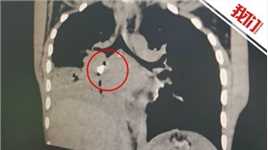 深圳一女童乳牙脱落呛入气管后长出肉芽 医生紧急手术取出