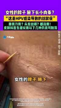 女性的脖子、腋下长小肉条？“这是HPV感染导致的丝状疣”用剪刀剪？头发丝绑？都没用！皮肤科医生建议用以下几种药膏可脱落