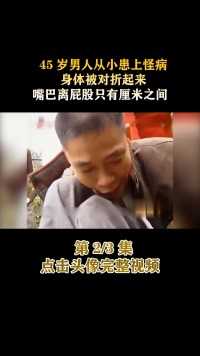 45岁男子从小患上怪病，身体被对折起来，嘴巴离屁股只有厘米之间#医者仁心#纪录片#家庭#社会百态 (2)