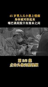 45岁男子从小患上怪病，身体被对折起来，嘴巴离屁股只有厘米之间#医者仁心#纪录片#家庭#社会百态 (3)