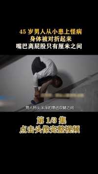 45岁男子从小患上怪病，身体被对折起来，嘴巴离屁股只有厘米之间#医者仁心#纪录片#家庭#社会百态 (1)
