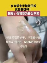 5月9日 山西 女大学生手被蚊子咬，竟然肿成这样！网友：你猜我为什么不笑 #搞笑 #夏日防蚊大作战