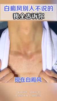 白癜风的秘密 全部在这里