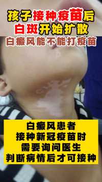 新冠疫苗和白癜风的关系具体在哪里 这个视频告诉你 都是真人真事