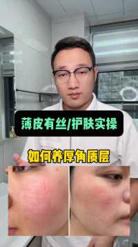 #敏感肌 #角质层薄 有 #红血丝 护肤细节你做对了吗？