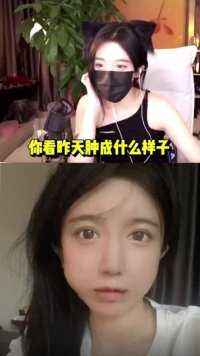 兄弟们拔完智齿四个大口子正常吗