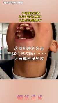 小时候没补钙，之后牙齿长这样？以后怎么娶媳妇？