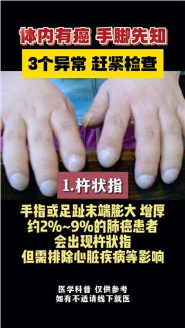 手脚一旦有这3种迹象，不能拖及时就医！#癌症 #中医 #肿瘤 #广东省名中医