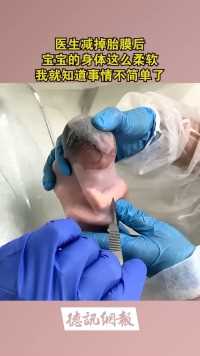 医生剪掉胎膜后，宝宝的身体这么柔软，我就知道事情不简单了！