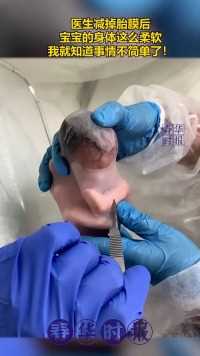 医生减掉胎膜后，宝宝的身体这么柔软，我就知道事情不简单了！