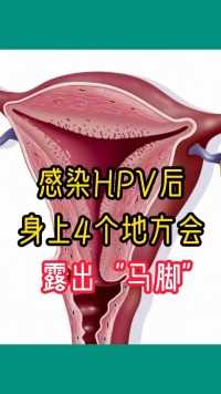 感染HPV后，身上4个地方会露出“马脚” #小妙招大用处 